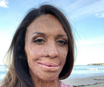A woman with long hair and burn scars on her face, standing on a beach with the sea in the background.