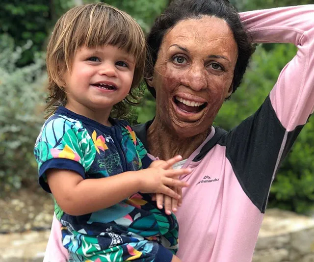 A woman with facial scars smiling while holding a young child, both outdoors and dressed in colorful clothing.