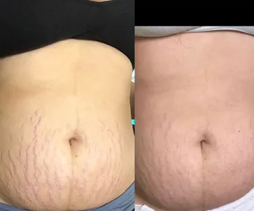 "Before and after comparison of stretch mark reduction on an abdomen using cream."