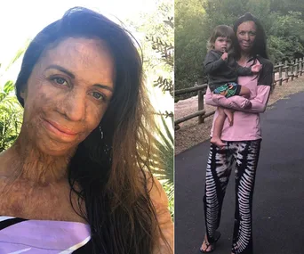 Burn survivor woman smiling outdoors; holding a child on a path in casual wear, surrounded by trees.