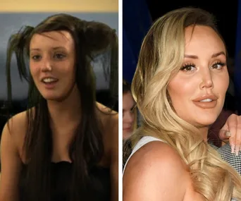 Comparison image of a woman before and after cosmetic procedures, showing notable facial differences.