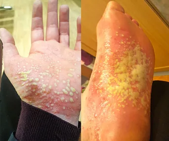 Hand and foot affected by psoriasis, showing red skin and pustules, typical signs of this skin condition.