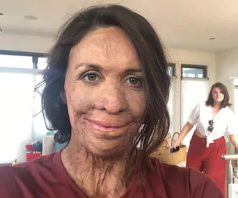 Burn survivor woman smiling indoors with another person in the background, light-filled room.