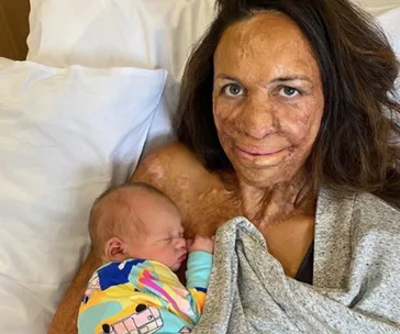 A woman with burn scars holds her newborn baby, both resting on a hospital bed.
