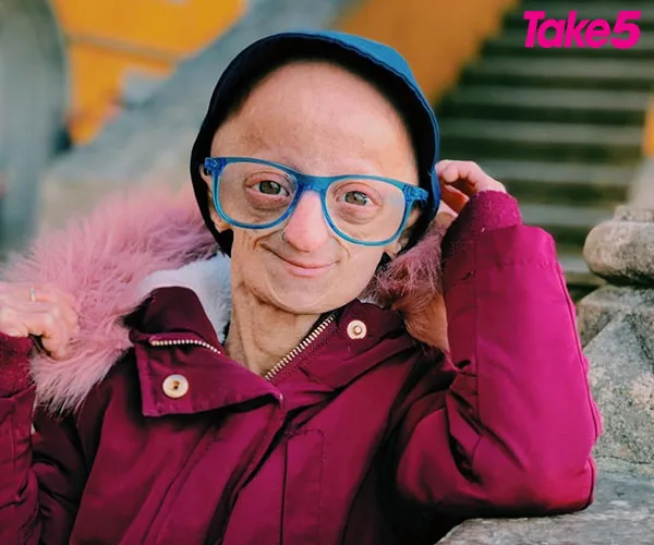 A person with Hutchinson-Gilford Progeria Syndrome smiles, wearing blue glasses, a maroon coat, and a fur-trimmed hood.