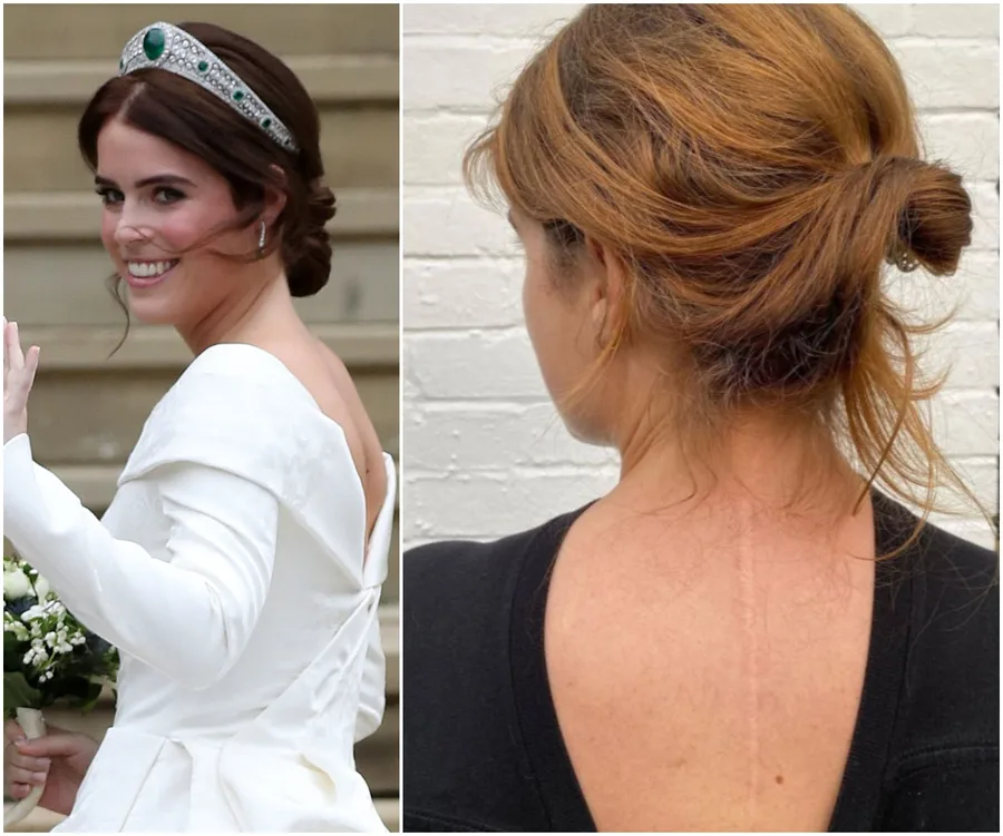 A woman in a white dress with a tiara on the left, and a woman with a visible back scar on the right.
