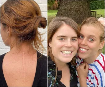"Two images: Left shows a woman’s back highlighting a vertical scar; Right shows two women smiling together outdoors."
