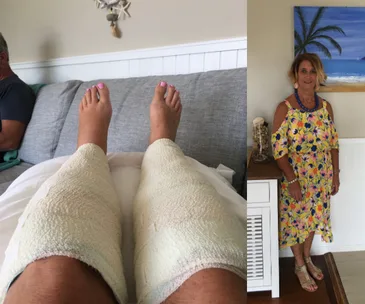 Bandaged legs resting on a couch; woman in floral dress stands beside.