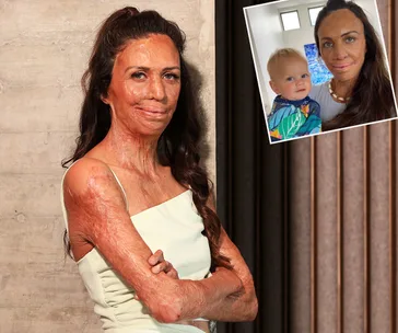 Woman in white dress with scars, smiling, arms crossed; inset photo of her holding a child.