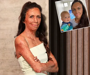 Woman in white dress with scars, smiling, arms crossed; inset photo of her holding a child.