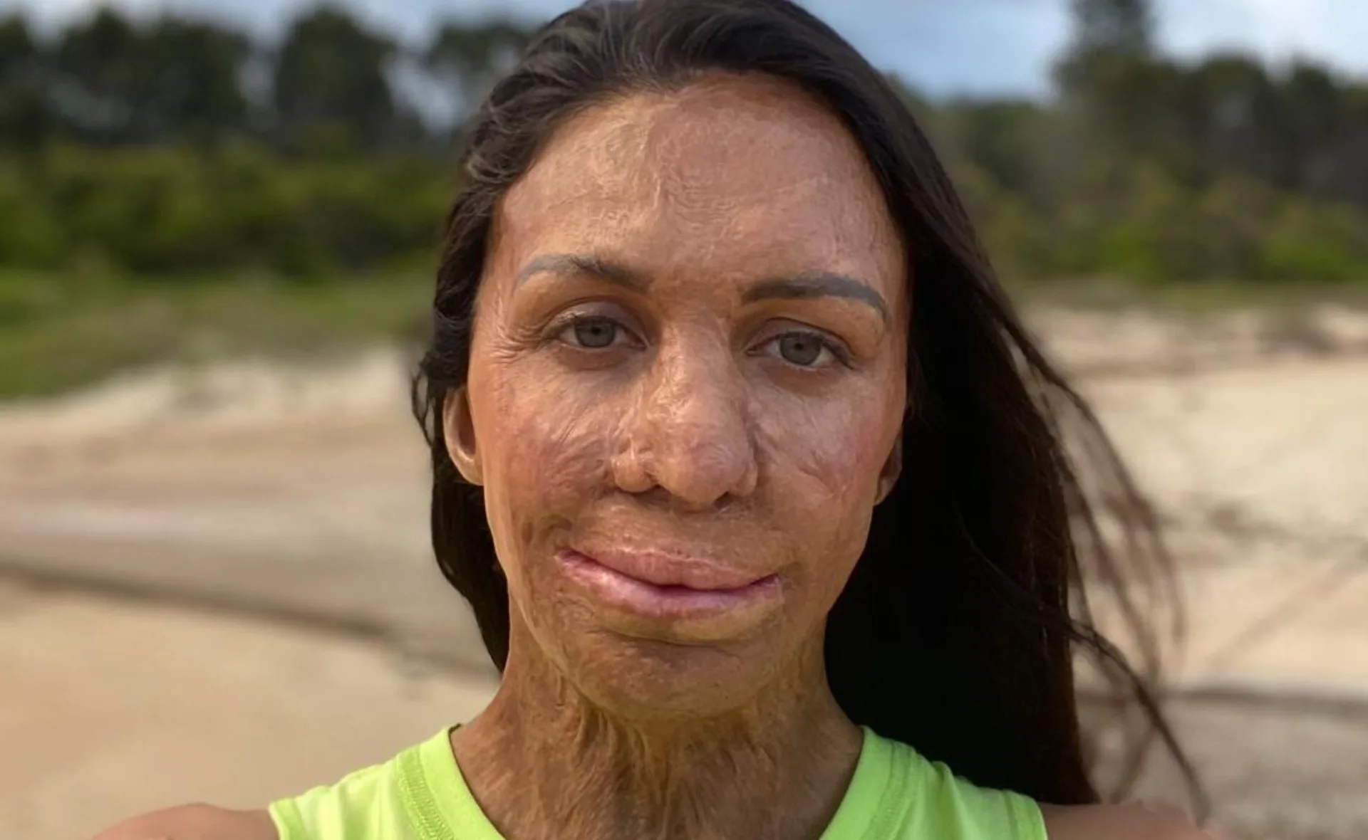 A woman with long hair and burn scars, wearing a green top, stands on a beach with trees in the background.