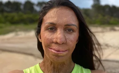 A woman with long hair and burn scars, wearing a green top, stands on a beach with trees in the background.