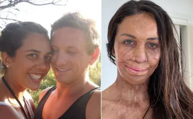 Couple smiling in pre-accident photo on left; woman with post-recovery scars on right, anniversary of accident.