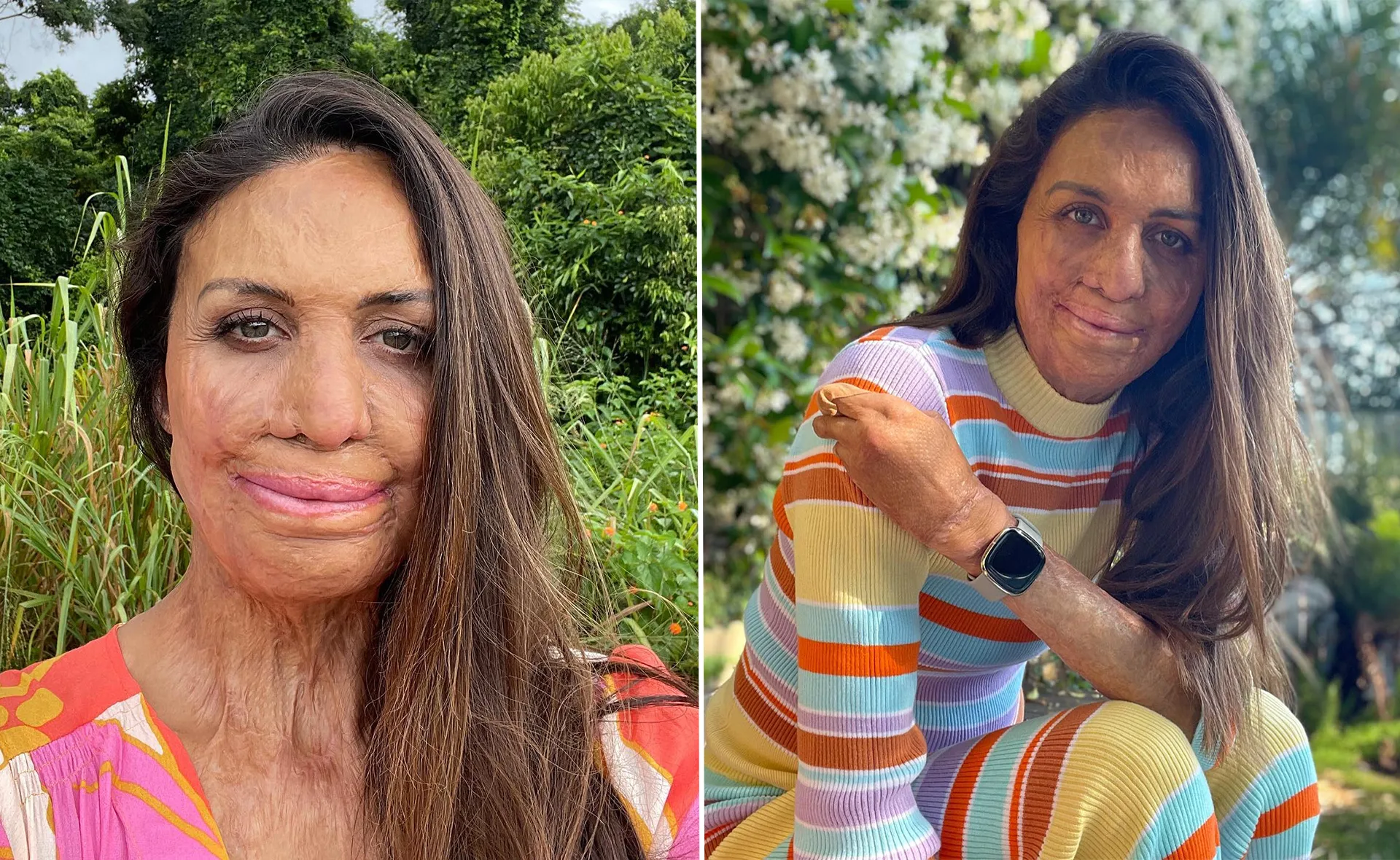 A woman with long hair and burn scars smiles outdoors in two different colorful outfits.