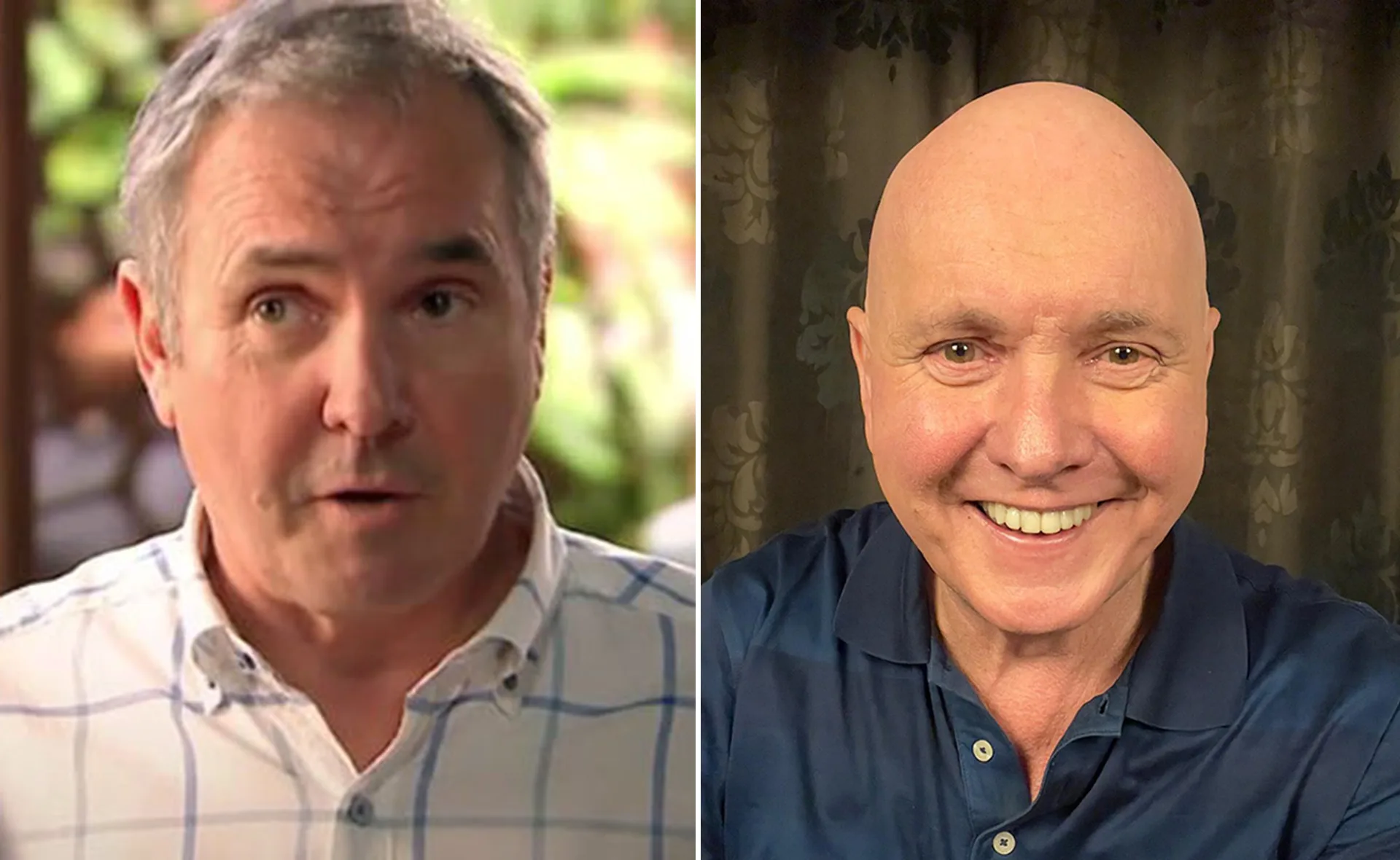"Side-by-side images of a man with hair and without, smiling in the second."