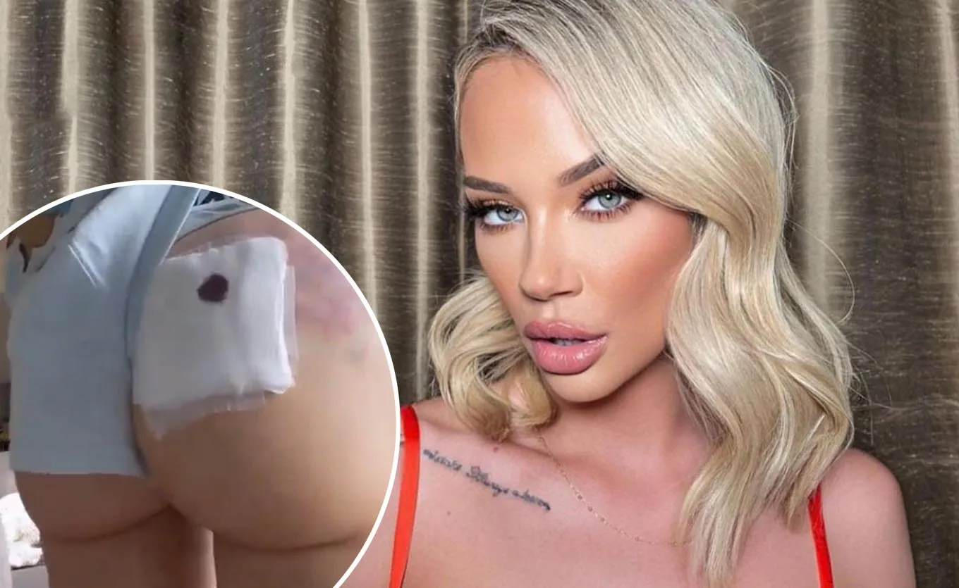 Blonde woman with makeup, red top; inset shows bandaged buttock post-surgery.