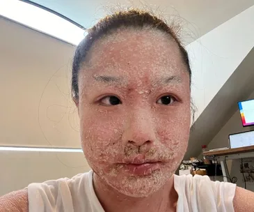 Person with eczema on their face, skin appears dry and flaky. They are indoors, wearing a white shirt.