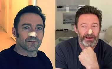 Man with a bandage on his nose, shown in two different settings, wearing dark shirts.