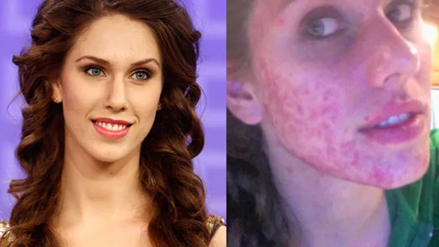 Model shows how she conquered acne