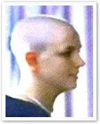 Person with a shaved head, profile view, indoors with striped background.