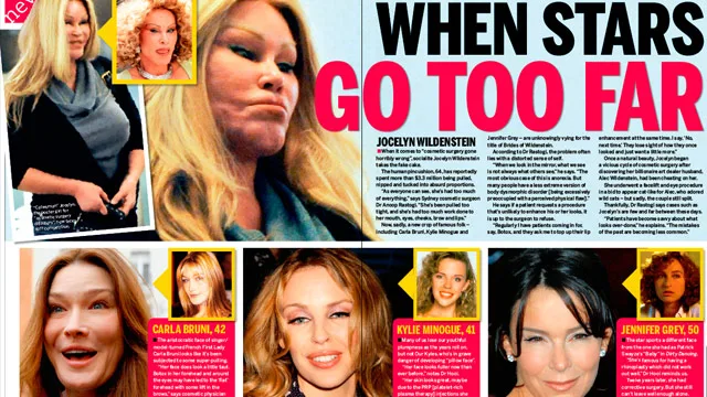 Plastic surgery: When stars go too far