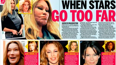 Plastic surgery: When stars go too far