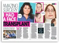 Alt text: "Magazine article titled 'Amazing Surgery: I Had a Face Transplant' with before and after photos of the patient."