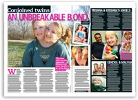 Conjoined twins pose together in a magazine spread titled "An Unbreakable Bond," featuring various photos and text.