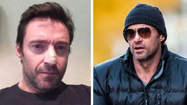 Hugh Jackman treated for skin cancer