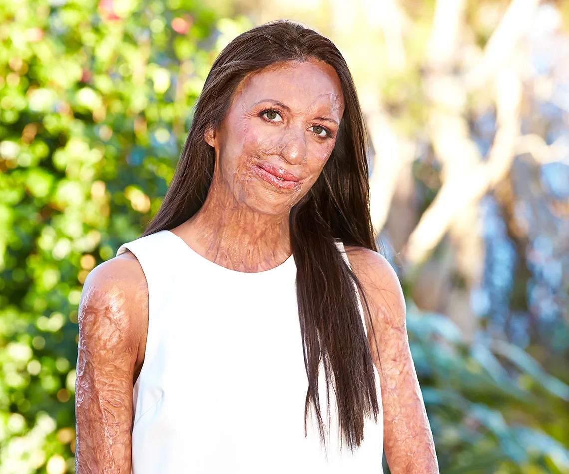 turia pitt nose