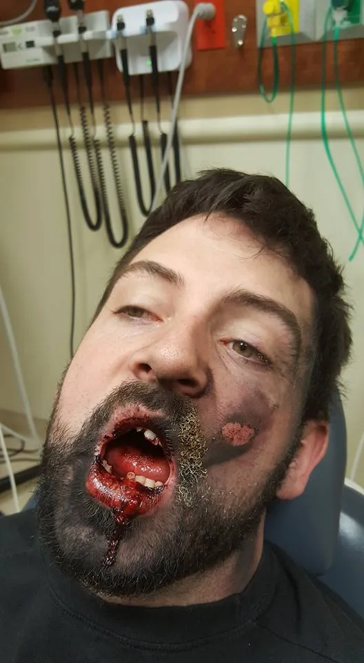 vape explosion injuries CBD Shop
