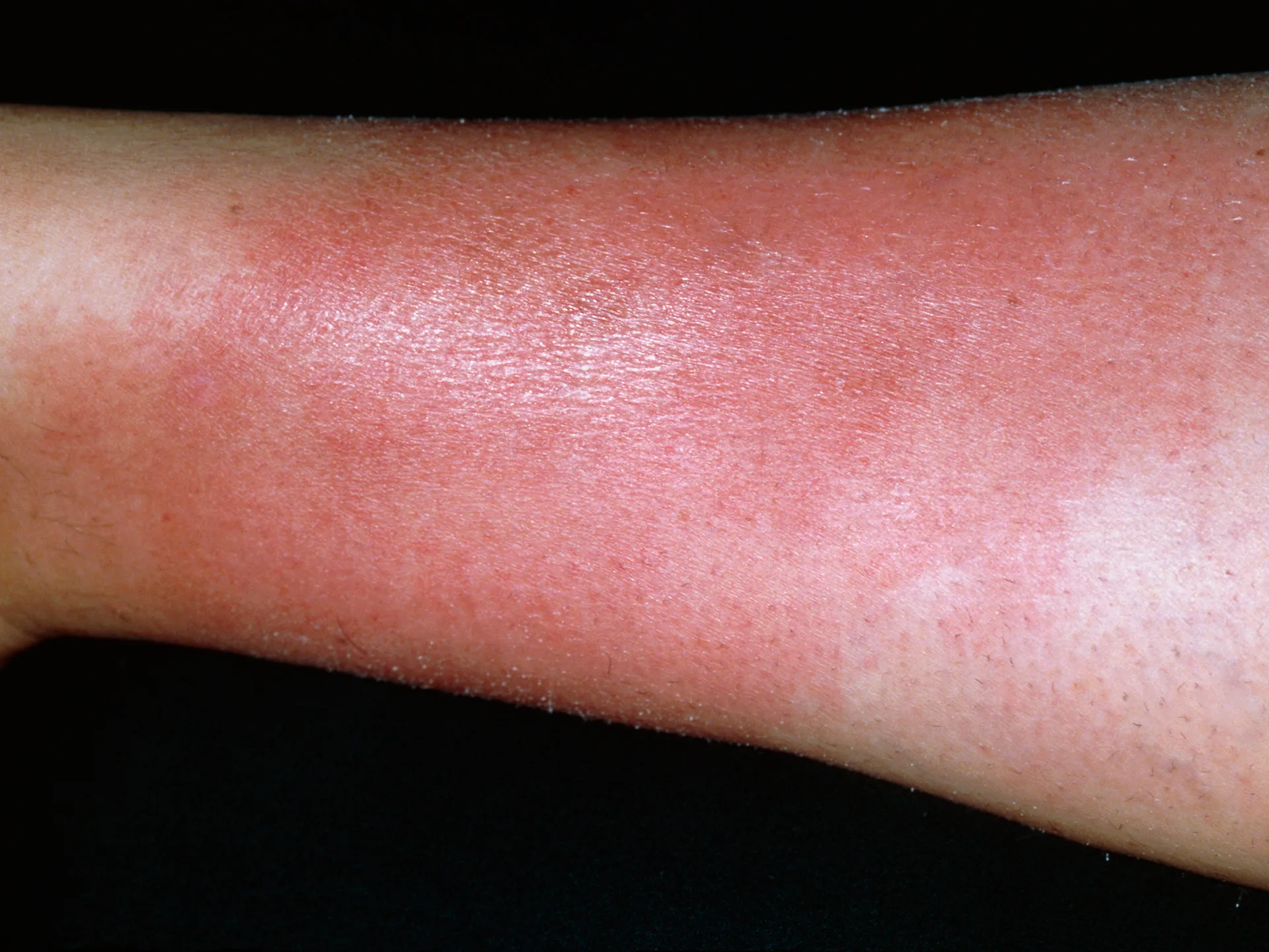What is cellulitis? Causes, symptoms and treatments