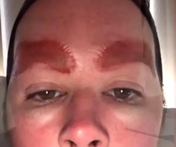 Mum who claims treatment infected brows is being sued