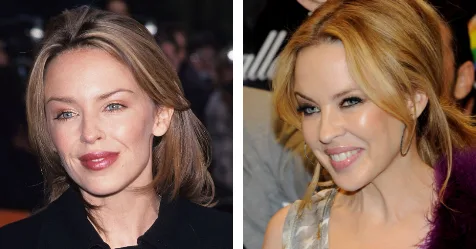 has kylie minogue had plastic surgery Image 3