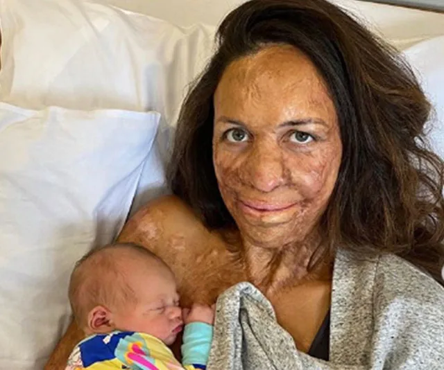 Mother with burn scars holds a newborn baby on her chest in a hospital bed, both look peaceful.