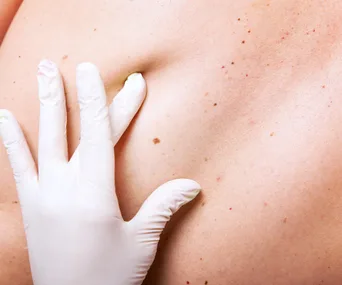 Doctor looking at skin cancer