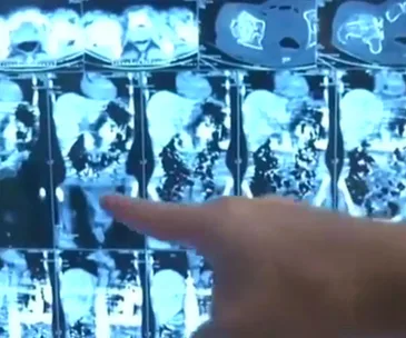 Man survives after swallowing 40 knives