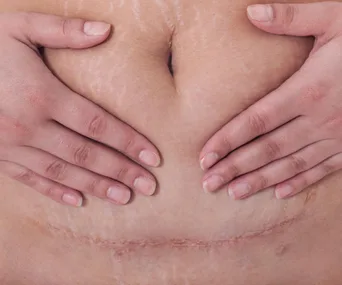 How C-sections might be changing human evolution