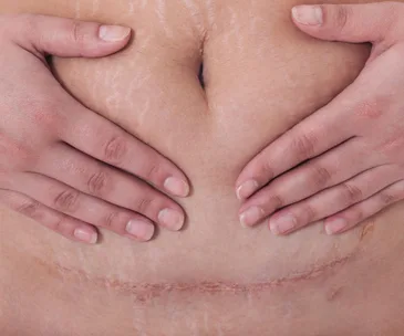 How C-sections might be changing human evolution