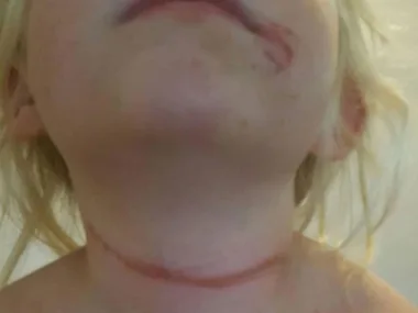 Six-year-old girl almost strangled by school hat