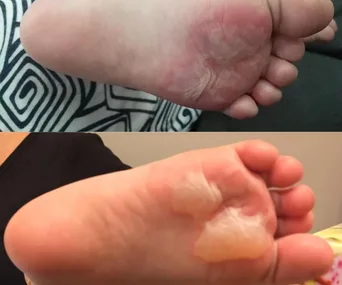 Toddler suffers second-degree burns from hot playground mat