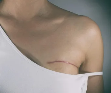 How having a double mastectomy tested my 23-year relationship
