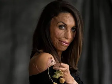 Turia Pitt has posted her first baby bump photo