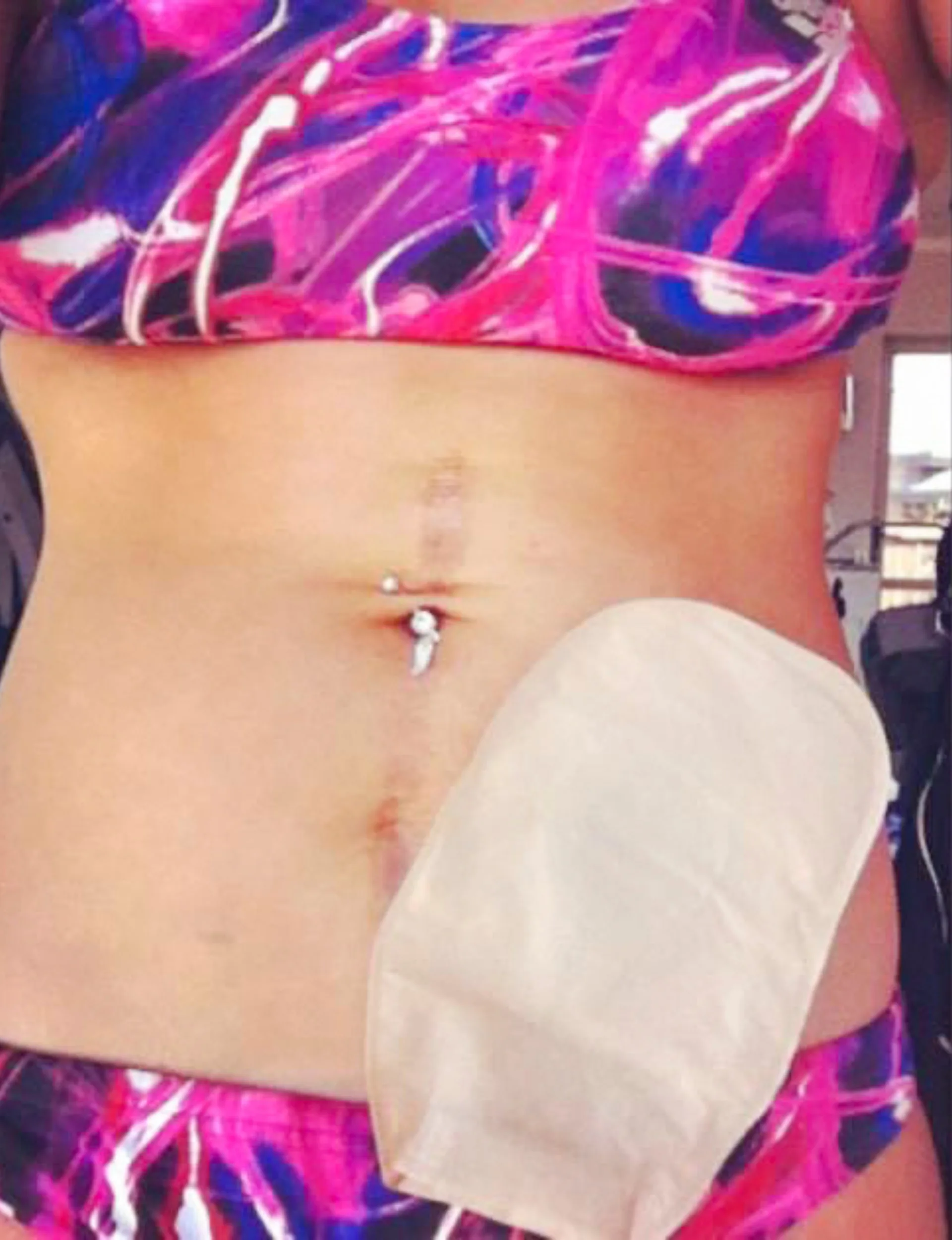 Nikki's stomach with a colostomy bag