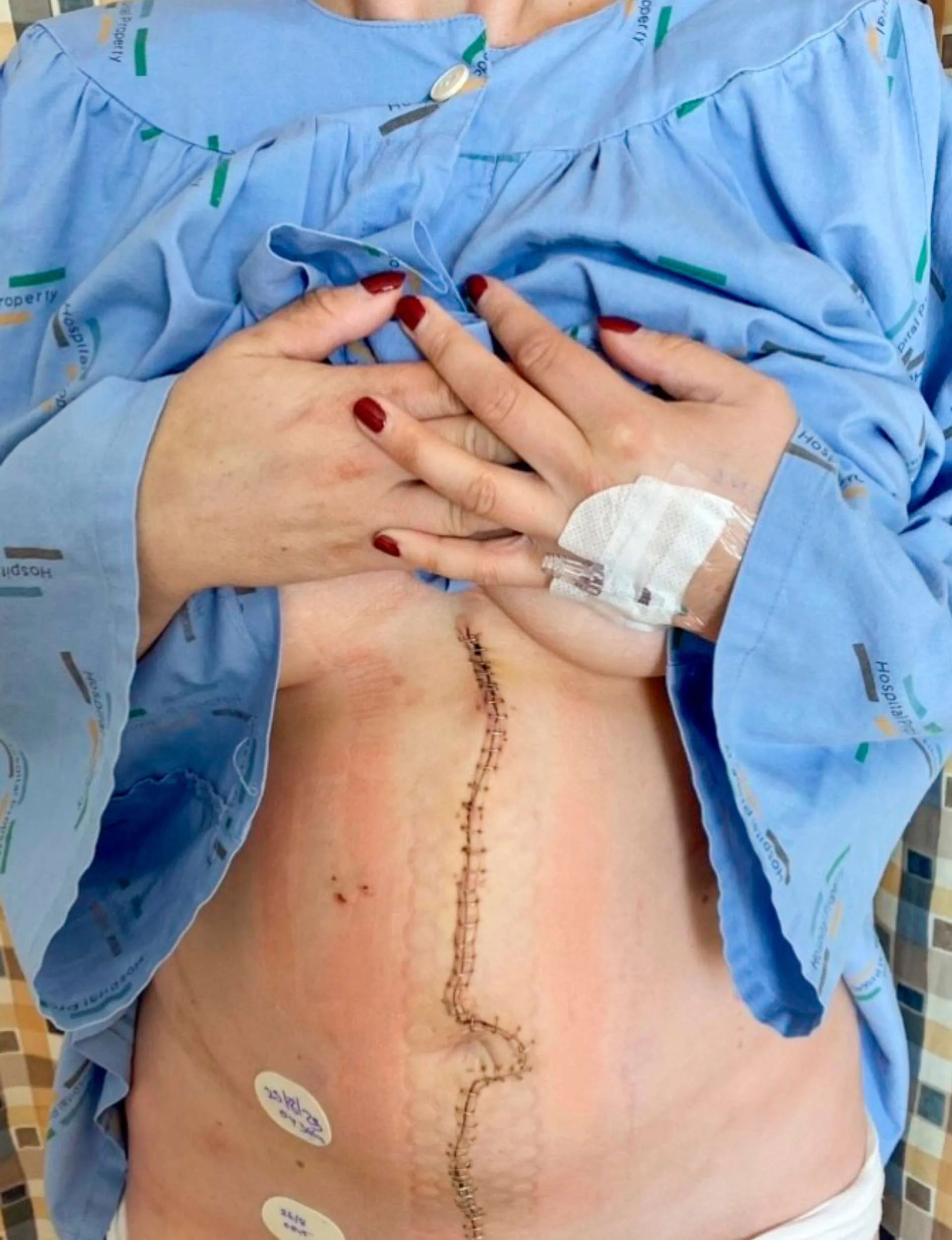 Holding her hospital gown up to reveal a freshly stapled incision from surgery that runs from between her breasts, around her belly button and down to her pelvis