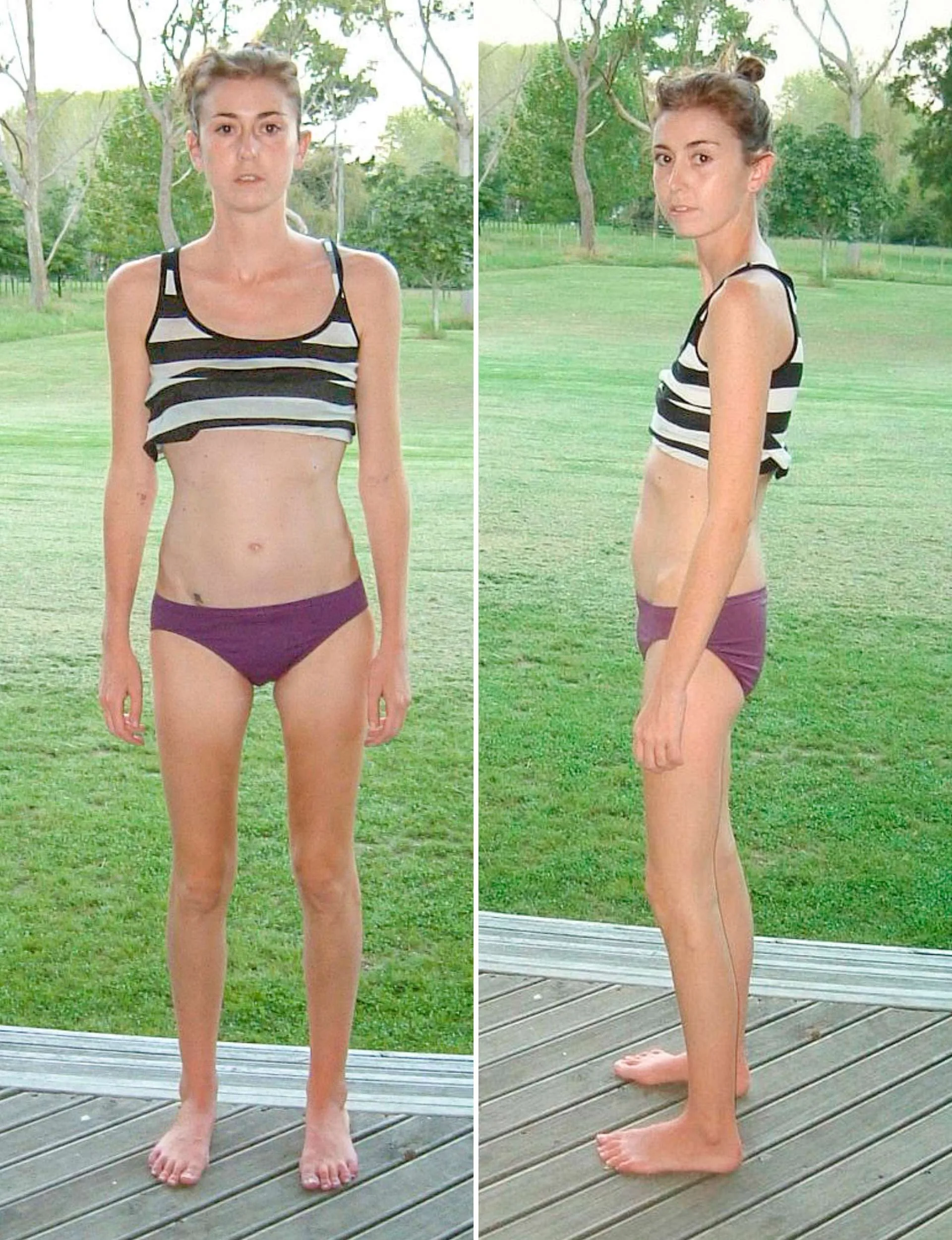 Two images side by side of Kate very skinny and frail looking