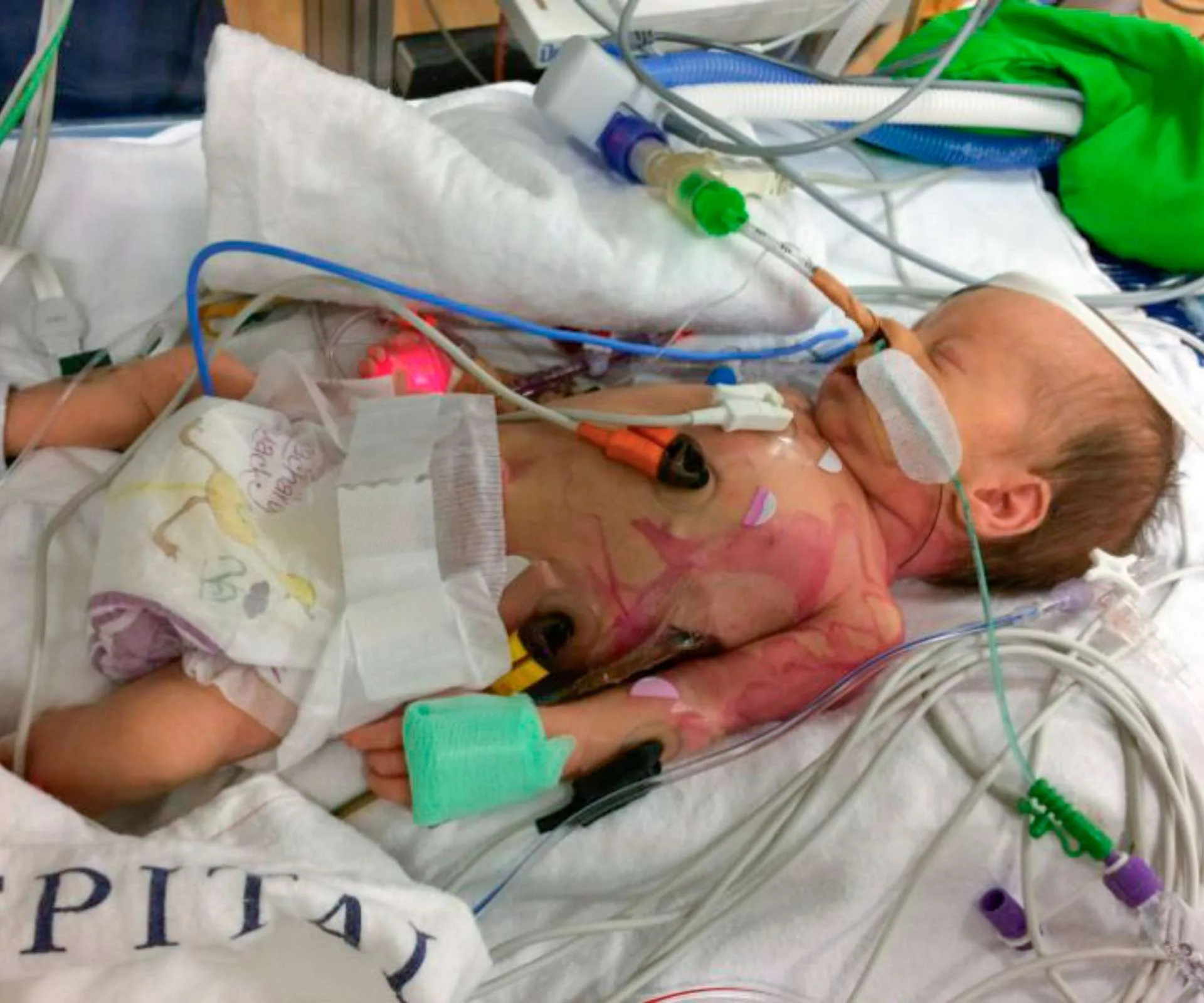 Aimee Vienings as a premature baby in hospital with tubes.