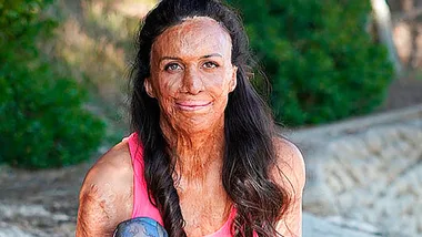Burn victim Turia’s incredible comeback