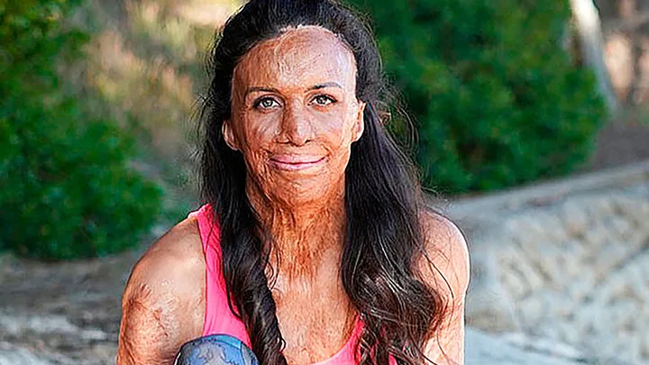 Burn victim Turia’s incredible comeback