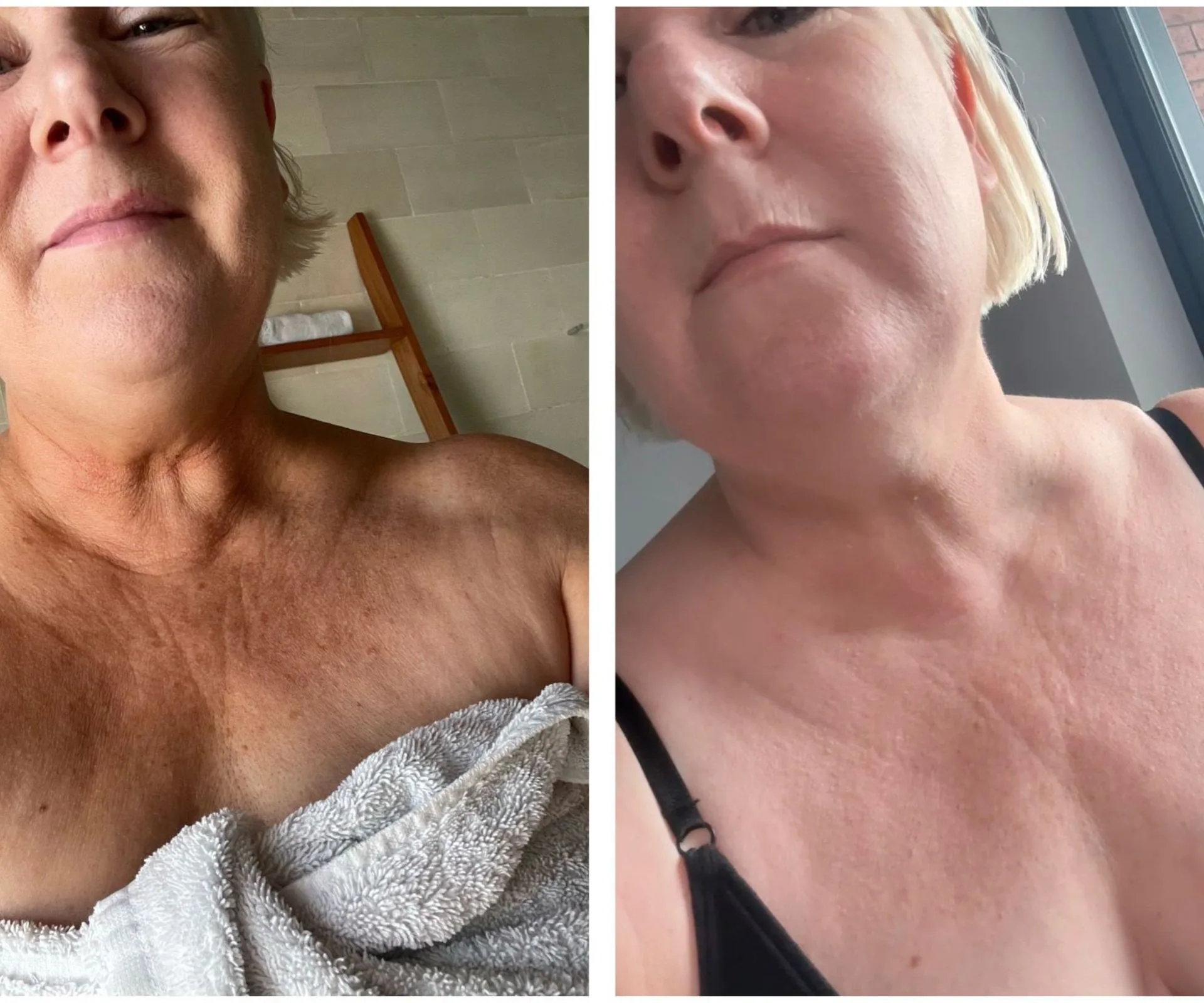 Jay-Jay Feeney using the neck serum before and after